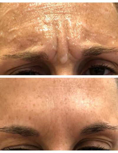 Botulinum toxin for frown lines