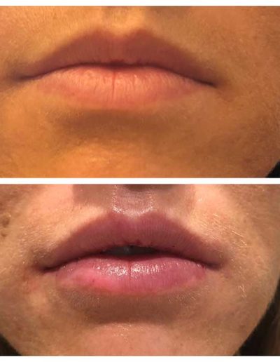 LIP AUGMENTATION