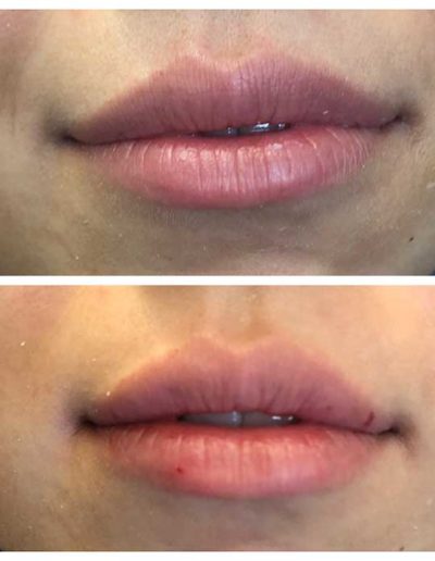 LIP AUGMENTATION