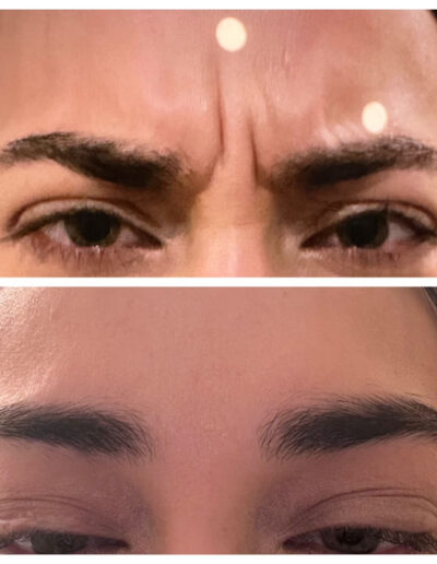 Botulinum toxin for brow and forehead lines