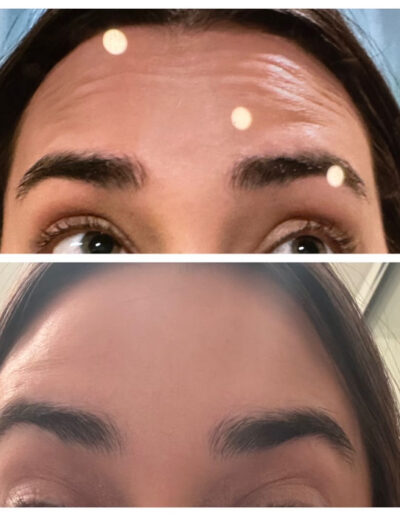 Botulinum toxin for brow and forehead lines