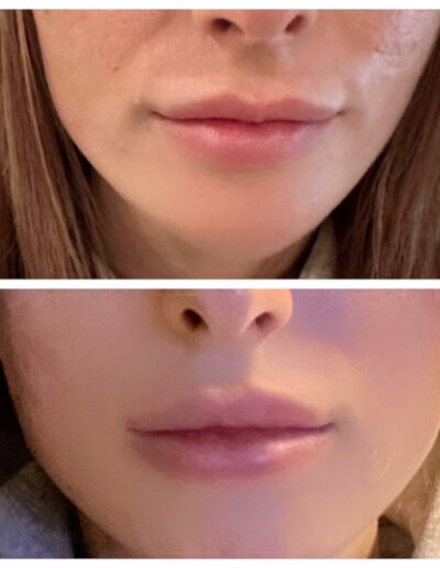 Dermal fillers to enhance the lower face